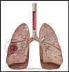Lung-cancer.jpg (28579 bytes)