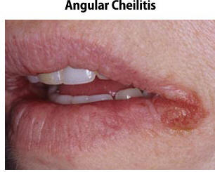 angular-cheilitis.jpg Angular Cheilitis Picture