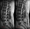 Spinal-Epidural-Lipomatosis_small.jpg