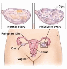 Ovarian Dermoid Cyst Picture