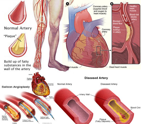 Cardiovascular-Disease.jpg