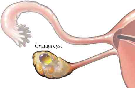 Ovarian-cyst.jpg (13796 bytes)