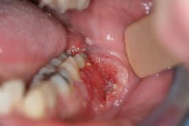 Oral-Cancer.jpg