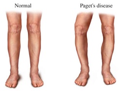Pagets-Disease.jpg