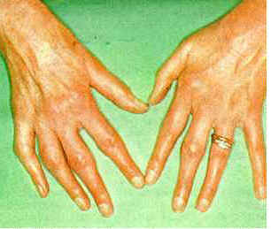 Arthritis hands