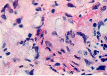 Blastomycosis