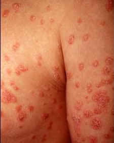 Guttate psoriasis on the arms and chest
