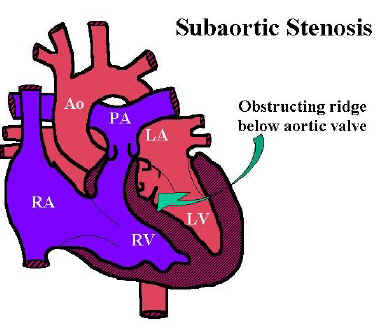 Idiopathic hypertrophic subaortic stenosis