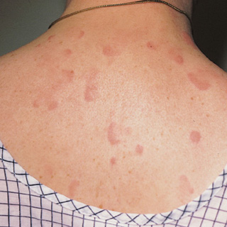 Hives | Rash | Skin Rash | Itchy Skin | MedlinePlus